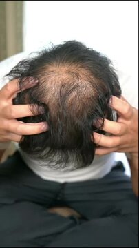 Balding Depressed Man Concerned About Hair Loss and Thinning Hair