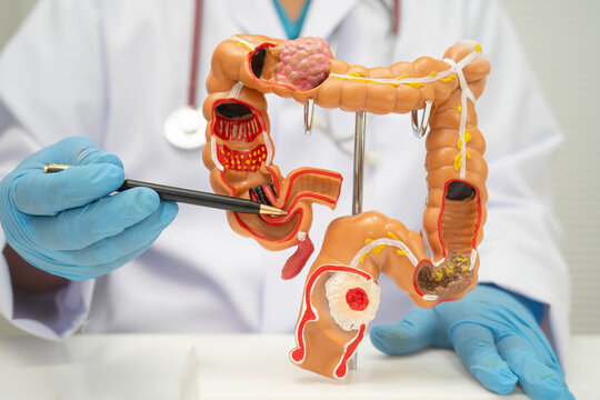 Colorectal cancer, doctor holding intestine colon human anatomy model.