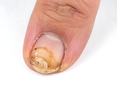 A close-up of a thumb with a discolored and damaged fingernail