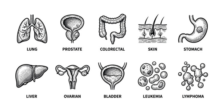 Set of ten cancer type icons in a vintage engraving style showing affected human organs like lung, prostate, stomach, and cells for leukemia and lymphoma