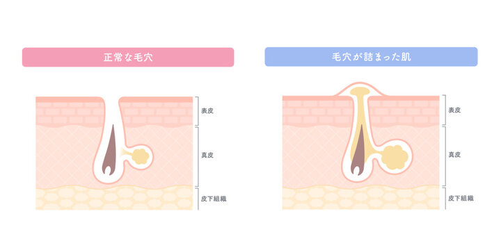 毛穴詰まりと正常な毛穴の比較イラスト（肌断面図）