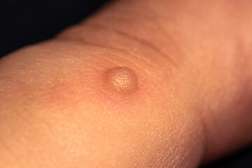 Fototapeta premium Blister on a finger from a skin burn closeup