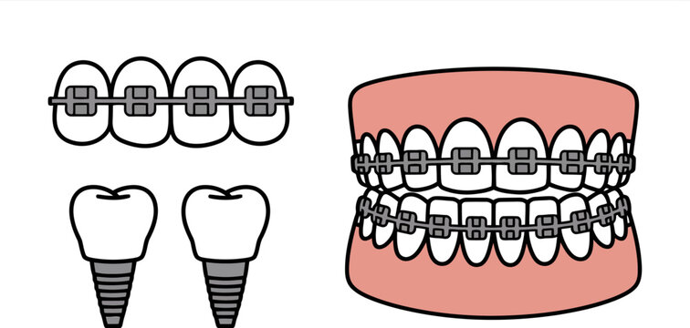 Cartoon dental implants and teeth with braces on a white background