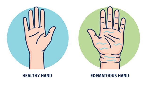 Hand medical comparison showing a healthy hand next to an edematous swollen hand with water retention signs in round icons.