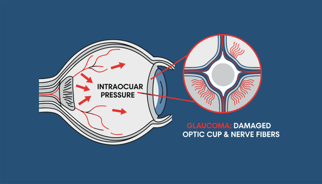 Ophthalmology diagram explaining glaucoma condition showing intraocular pressure and damaged optic nerve.
