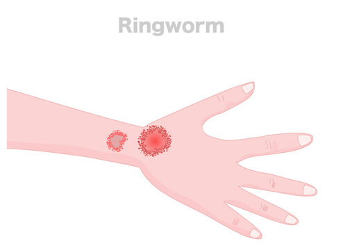 Ringworm is a common fungal skin infection on hand, feet, head. Tinea manuum. A ring of bumps surrounds the center of the infection. Dermatological diseases.  Illustration vector
