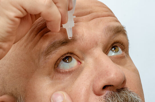 Close up of man using eye drops to moisturize eyes. Dry eye syndrome, vision health, allergy relief.