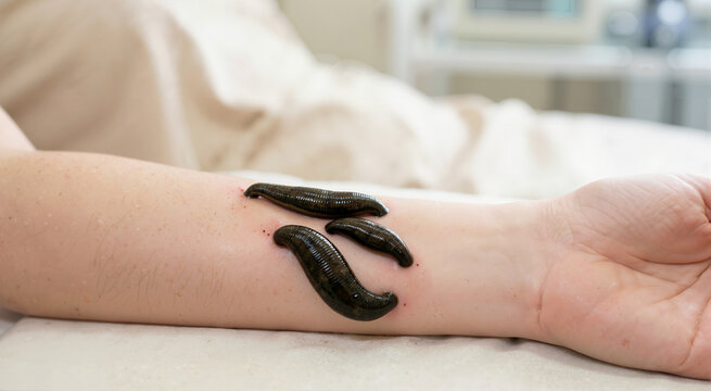 Three medical leeches attached to a patient's arm drawing blood. Close-up of alternative medicine hirudotherapy treatment in a clinical setting