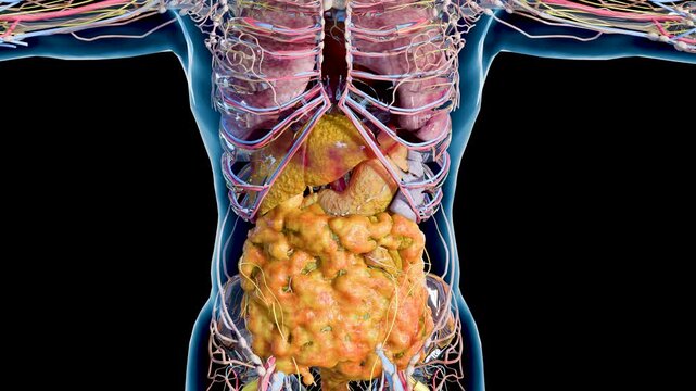 Progressive Accumulation of Visceral Fat and Fatty Liver Disease, Metabolic Syndrome and Internal Fat Gain, Liver and Abdominal Fat Progression, Advanced Steatosis and Visceral Obesity, 3d render