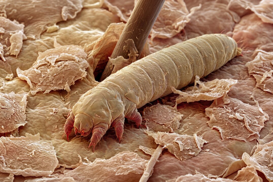 A Demodex hair follicle mite on human skin surface