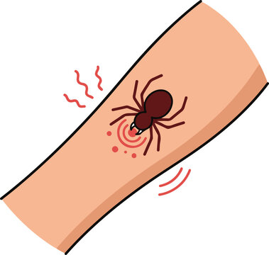 Tick bite causing skin irritation vector illustration showing a parasitic tick attached to human skin with redness, itching, and inflammation symptoms.