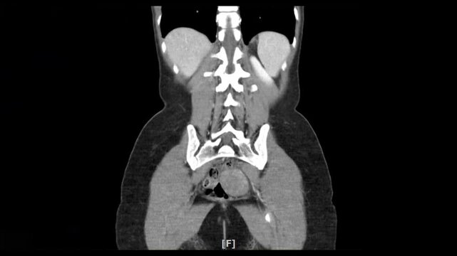 x-ray scan of front body by mri ct scan Internal Organs and Liver,Lungs,Intestines,Stomach,Bladder,Kidneys.	