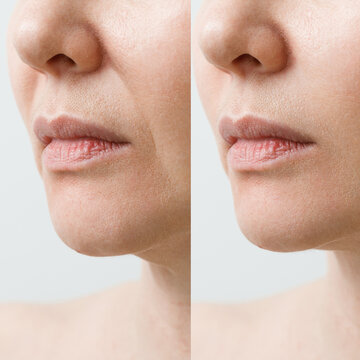 A closeup of a woman face showcasing remarkable skin texture transformation after beauty care