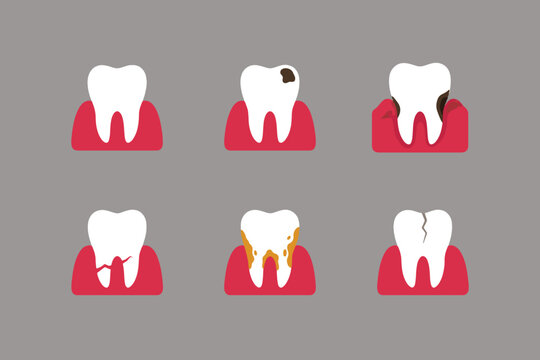 Cute dental conditions infographics chart flat vector illustration set of tooth decay and dental problems