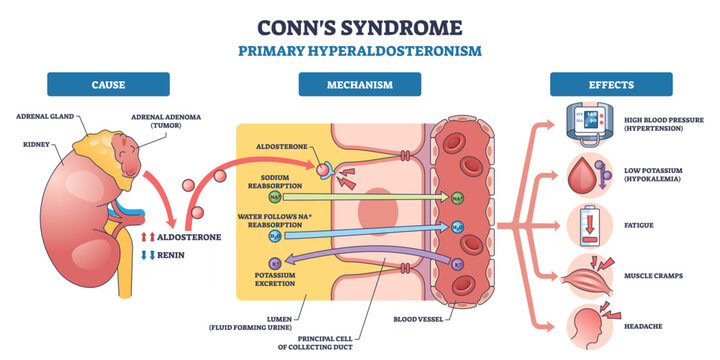Conns syndrome outline shows excess aldosterone from adrenal adenoma causing sodium reabsorption and hypertension, key objects, adrenal gland, kidney, blood vessel, transparent background.