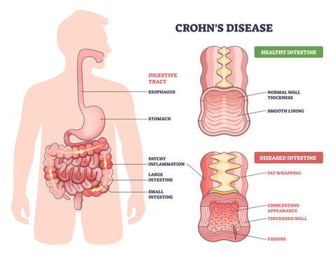 Crohn s disease diagram contrasts healthy and diseased intestine, highlighting patchy inflammation, key objects, intestines, digestive tract cross-sections, transparent background