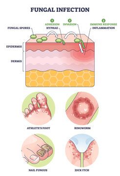 Fungal infection diagram shows spores and hyphae invading skin layers and triggering inflammation, key objects, skin layers, fungal spores, hyphae, transparent background