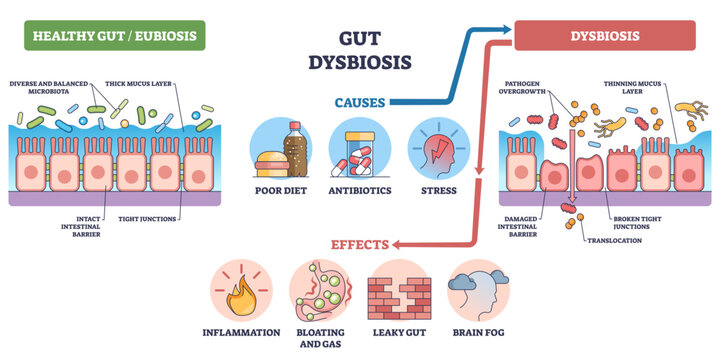 Gut dysbiosis outline shows shift from healthy microbiota to damaged intestinal barrier, highlighting epithelial cells, pathogens, and causes like diet, antibiotics, stress, transparent background.