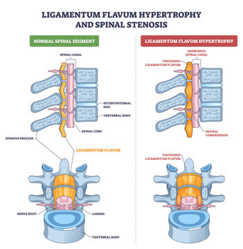 Ligamentum flavum hypertrophy spinal stenosis shown, thickened ligamentum flavum narrows the spinal canal and compresses nerve roots, key, ligamentum flavum, spinal canal, nerve root,