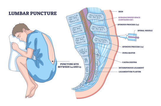 Lumbar puncture brief diagram shows curled patient and spinal needle entering L4 L5 for CSF access, highlighting vertebrae, key objects, patient, needle, vertebrae, transparent background.