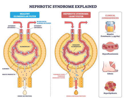 Nephrotic syndrome overview, side-by-side glomeruli show healthy vs leaky filter leading to proteinuria, key objects, glomerulus, albumin leak, urine drop, transparent background