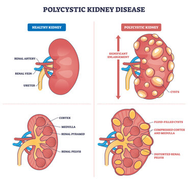 Polycystic kidney disease diagram shows enlarged kidney with fluid-filled cysts, comparing healthy vs PKD, highlights cortex, medulla, renal pelvis, transparent background