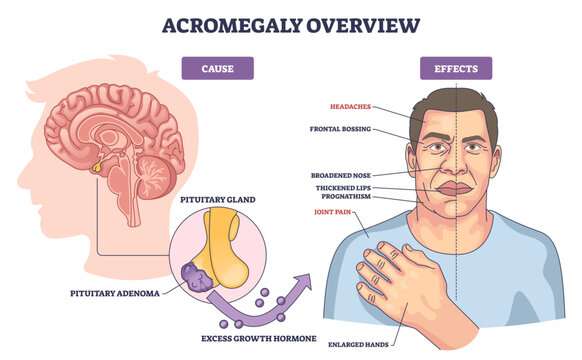 Acromegaly overview shows pituitary gland tumor causing excess growth hormone and facial changes with enlarged hands, concise explainer of cause and effects, transparent background