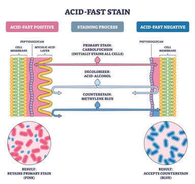 Acid-fast stain process compares positive vs negative cells, showing carbolfuchsin, acid-alcohol, methylene blue, key objects, mycolic acid layer, cell wall, bacilli, transparent background.