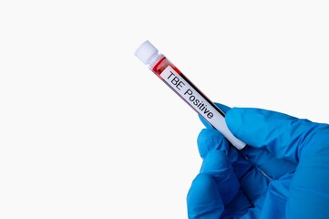 Obraz premium Tick borne Encephalitis Blood Sample Test Tube
