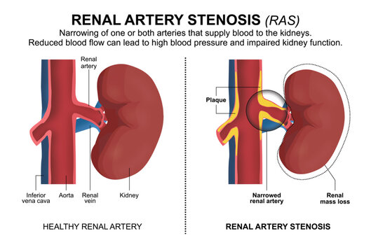 Renal Artery Stenosis (RAS), Kidney Illustration