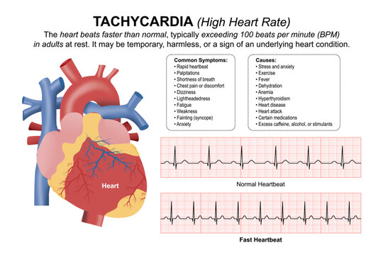 Tachycardia (High Heart Rate) Illustration