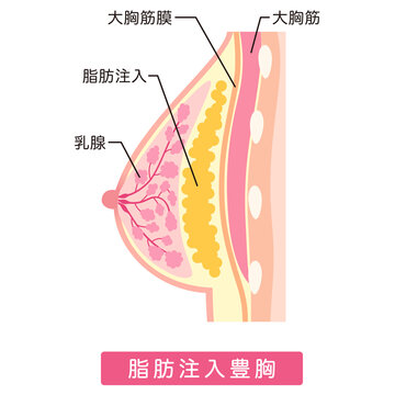 脂肪注入豊胸　豊胸手術の種類　美容整形　胸