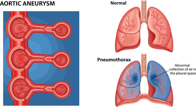 Detailed Medical Illustration Comparing Aortic Aneurysm and Pneumothorax Lung Conditions with Labeled Diagrams Vector Set