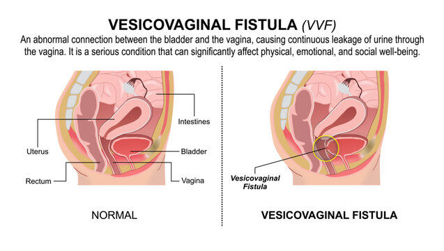 Vesicovaginal Fistula (VVF) Flashcard Illustration