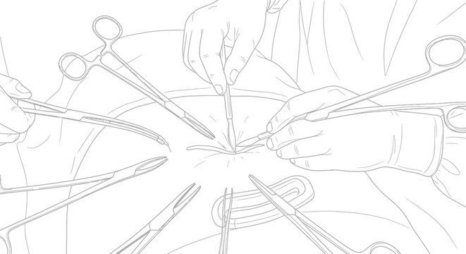 Line art illustration of a surgical procedure, showing surgeon hands with medical instruments during an operation.