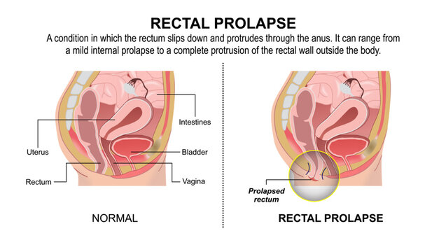 Rectal Prolapse, Rectum Flashcard Illustration