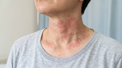 Naklejka premium Close up of red allergic rash and atopic dermatitis inflammation on woman neck skin texture for dermatological medical treatment clinical ad.