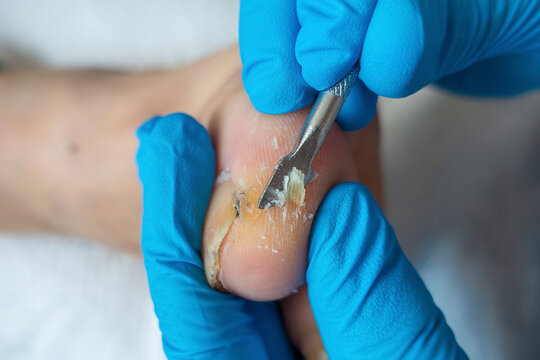 Removal of Thick Callused Skin from Toe During Professional Foot Care
