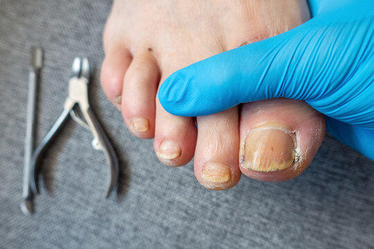 Podiatry Examination of Male Foot with Medical Gloves and Treatment Tools