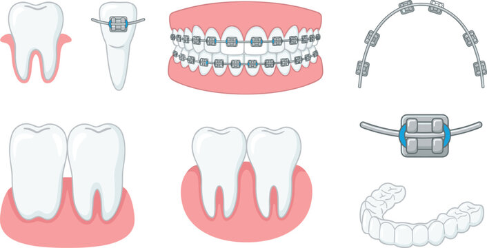 Orthodontic dental care vector set featuring teeth with metal braces clear aligners brackets wires human jaws and gums for dentistry and medical graphic designs