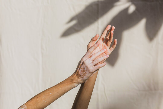 Caucasian woman's' hand with vitiligo 