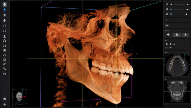 Detailed 3D CBCT reconstruction of human skull and jaws on dental diagnostic software screen, orthodontic planning,