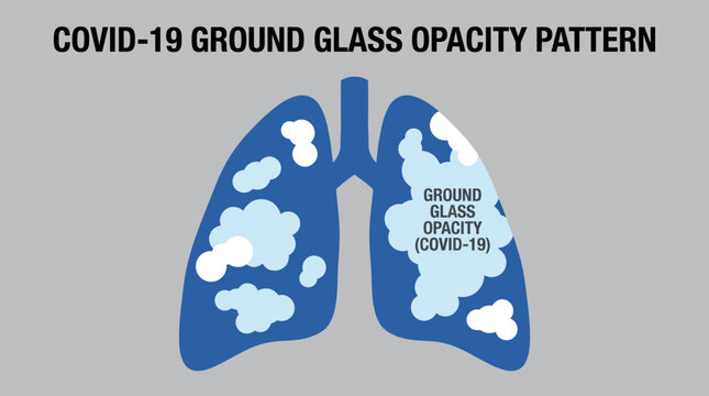 COVID-19 Ground Glass Opacity Pattern in Infected Lung Tissue