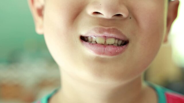 4K close up of Asian boy mouth smiling showing crooked front teeth and dry chapped lips, child dental health care problem, malocclusion and orthodontic concept, pediatric dentistry.
