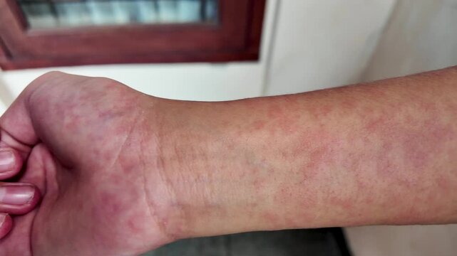 Red skin rash and allergic reaction on man wrist and hand