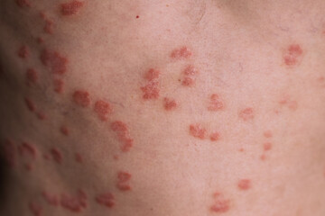 Fototapeta premium Close-up image of skin with psoriasis displaying red patches and scaling, highlighting the texture and condition of the affected area
