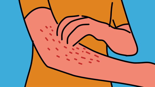 Rash on hand - symptom of diabetes, color vector illustration.