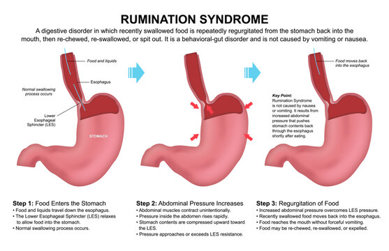 Rumination syndrome, Stomach Flashcard Illustration