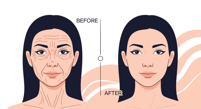 Facial rejuvenation comparison of a woman before and after anti aging treatment showing wrinkle reduction and smooth skin.