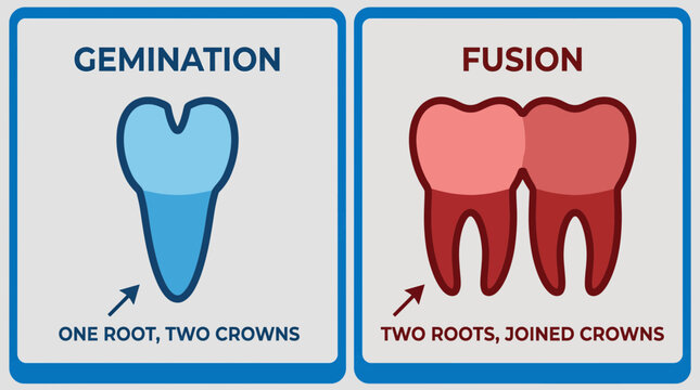 Gemination Fusion Dental Anomaly Comparison